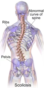 scoliosis-back pain