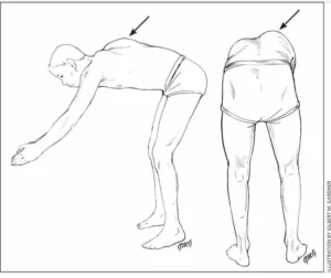 self test scoliosis