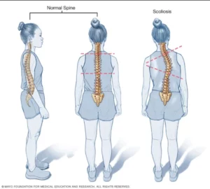 treatment-scoliosis-physical-therapy-non-surgery