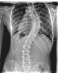 xray-Scoliosis